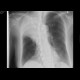 Atelectasis and tumorous infiltration of right upper lobe: X-ray - Plain radiograph